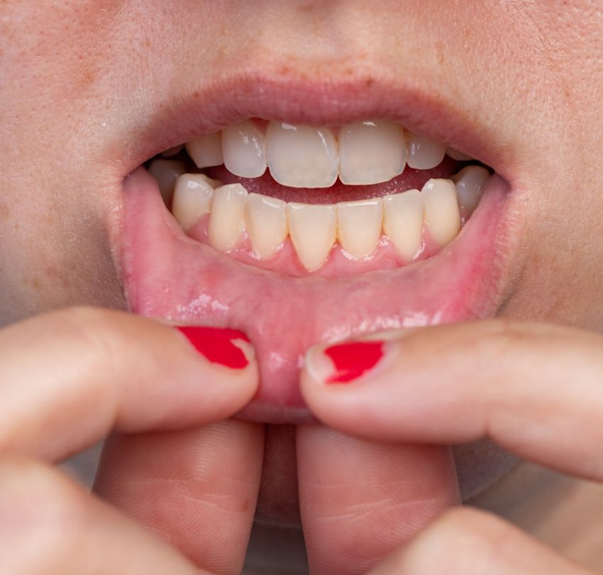 Gum Disease Treatment