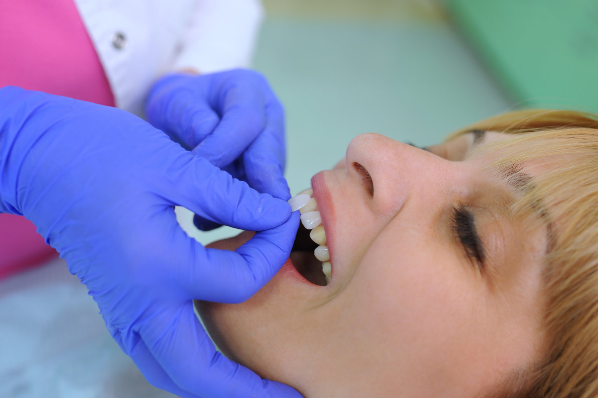 Dental Veneers vs. Crowns: Choosing the Right Cosmetic Solution in Boulder