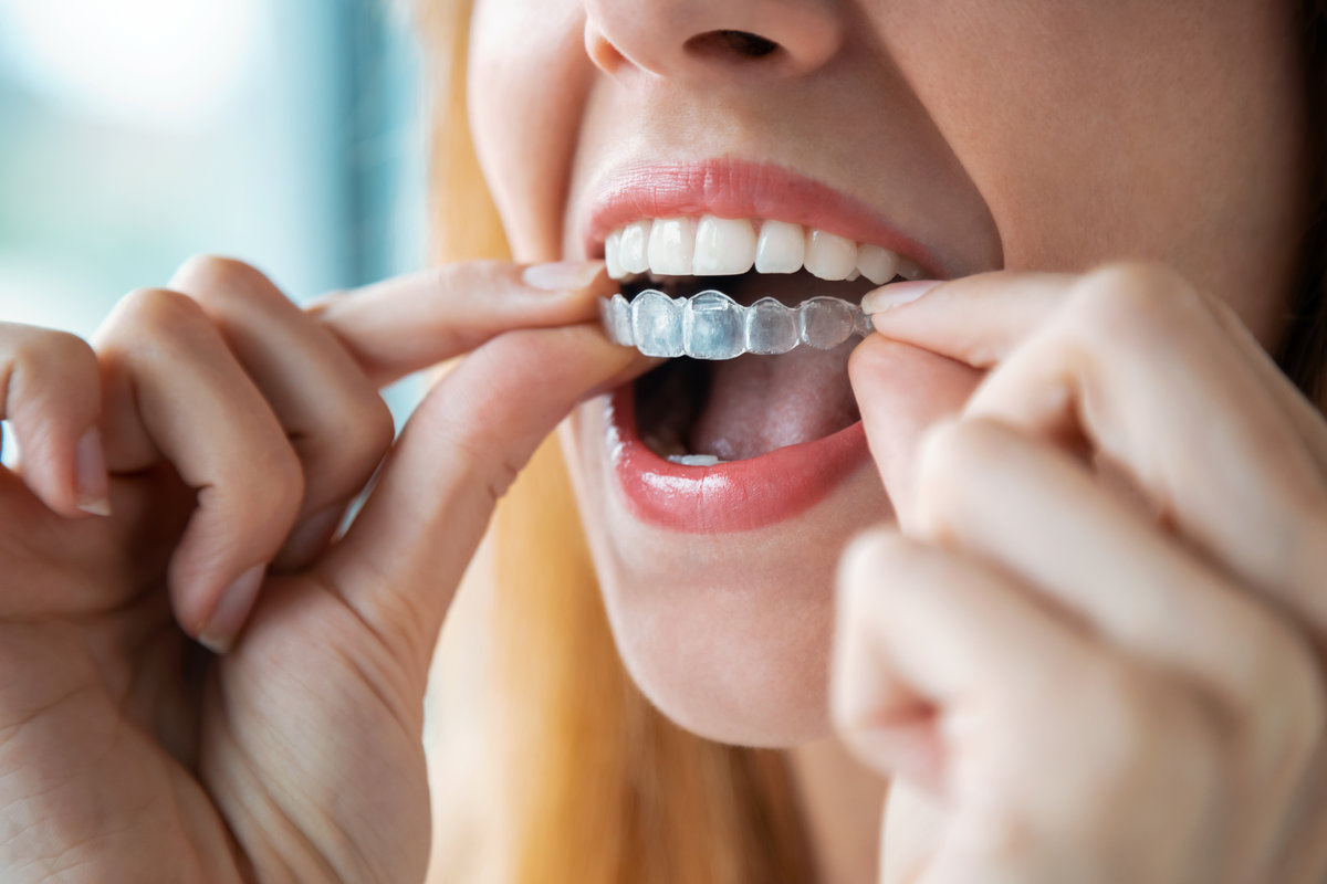 Combining Invisalign with Cosmetic Dentistry: Your Complete Boulder Smile Transformation
