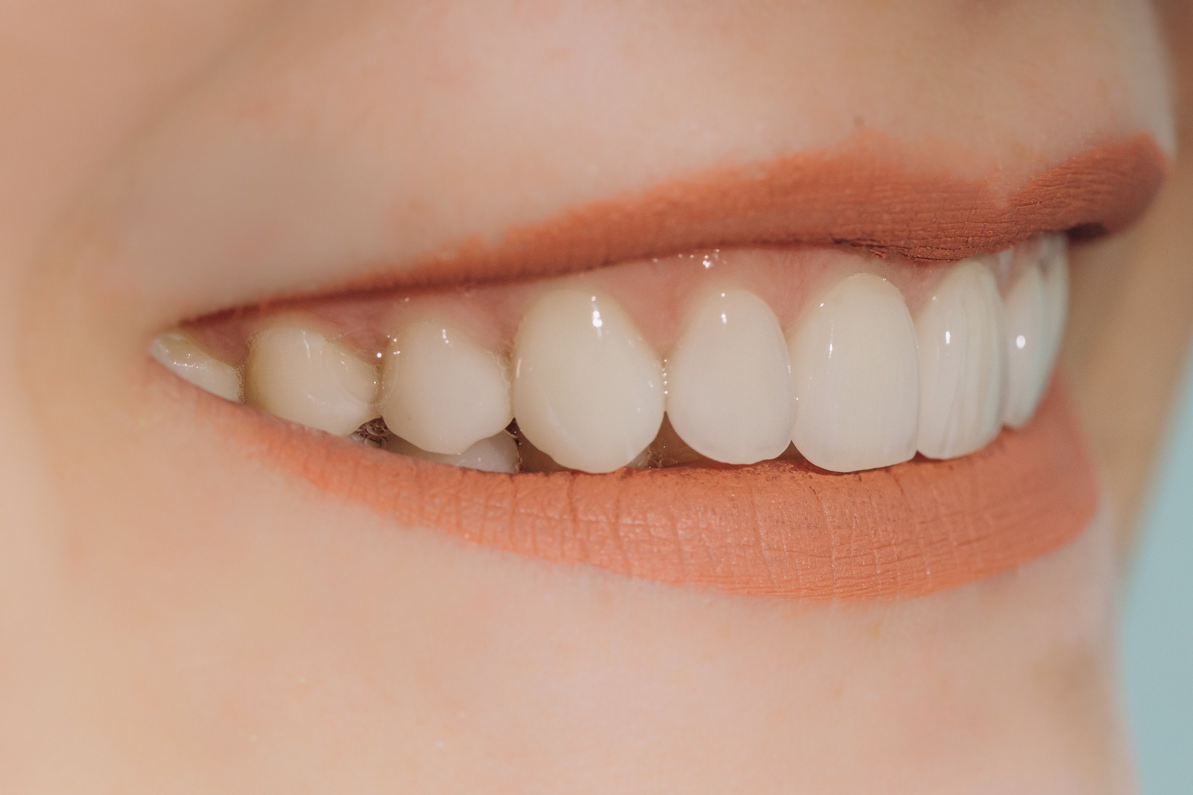 Hollywood smile result showing porcelain crowns and veneers